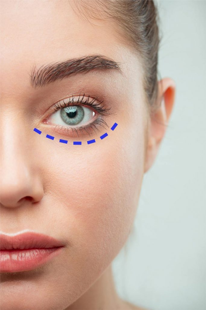 Blefaroplastia