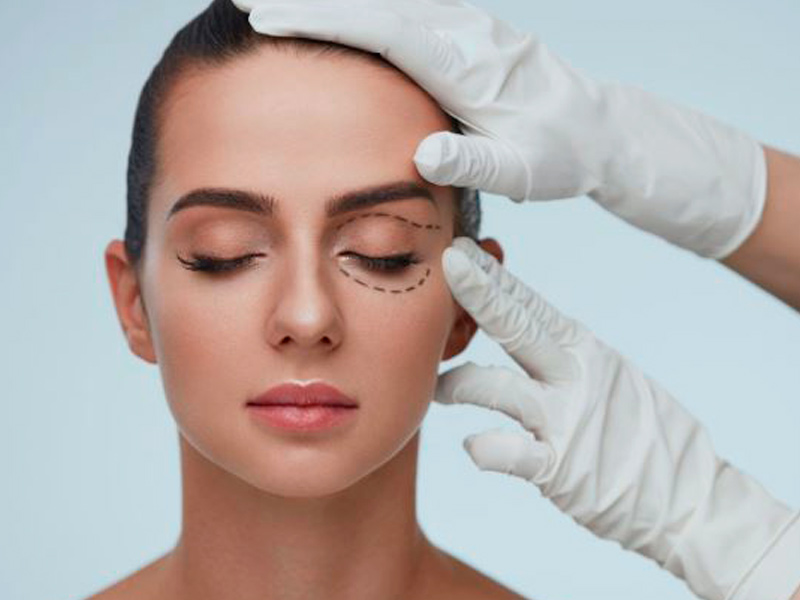 Blefaroplastia
