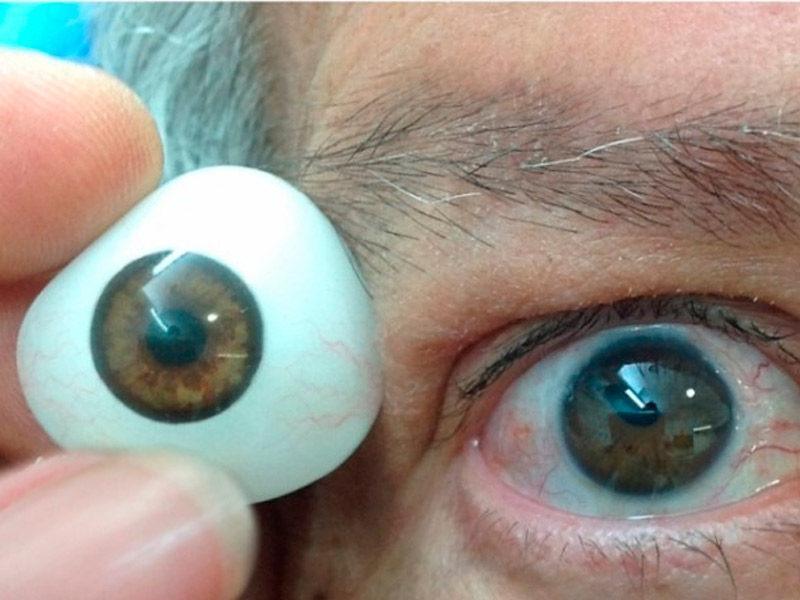 Prótesis ocular
